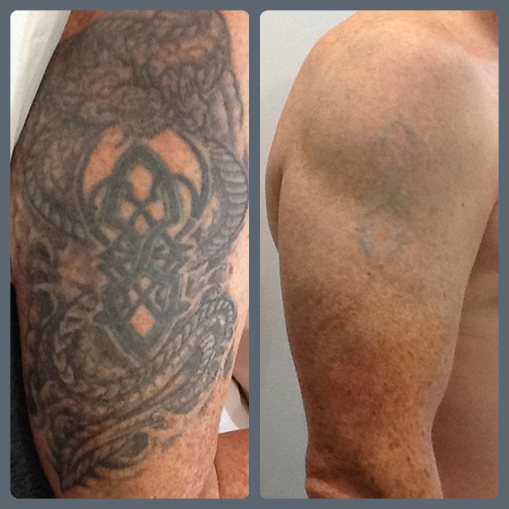 Natural Tattoo Removal Cream | #1 Pain Free Tattoo Removal | SKINTRU